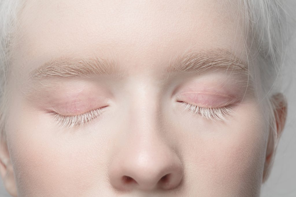 albino ocular